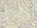 Immunohistochemistry of paraffin-embedded human gastric cancer using CSB-PA891539YA01HU at dilution of 1:100