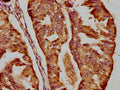IHC image of CSB-PA891575LA01HU diluted at 1:200 and staining in paraffin-embedded human endometrial cancer performed on a Leica BondTM system. After dewaxing and hydration, antigen retrieval was mediated by high pressure in a citrate buffer (pH 6.0). Section was blocked with 10% normal goat serum 30min at RT. Then primary antibody (1% BSA) was incubated at 4°C overnight. The primary is detected by a biotinylated secondary antibody and visualized using an HRP conjugated SP system.