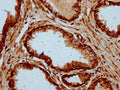 IHC image of CSB-PA891722LA01HU diluted at 1:500 and staining in paraffin-embedded human prostate cancer performed on a Leica BondTM system. After dewaxing and hydration, antigen retrieval was mediated by high pressure in a citrate buffer (pH 6.0). Section was blocked with 10% normal goat serum 30min at RT. Then primary antibody (1% BSA) was incubated at 4&deg;C overnight. The primary is detected by a biotinylated secondary antibody and visualized using an HRP conjugated SP system.