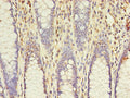 Immunohistochemistry of paraffin-embedded human colon cancer using CSB-PA891734LA01HU at dilution of 1:100