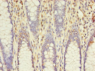 Immunohistochemistry of paraffin-embedded human colon cancer using CSB-PA891734LA01HU at dilution of 1:100