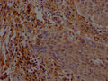IHC image of CSB-PA892141LA01HU diluted at 1:200 and staining in paraffin-embedded human cervical cancer performed on a Leica BondTM system. After dewaxing and hydration, antigen retrieval was mediated by high pressure in a citrate buffer (pH 6.0). Section was blocked with 10% normal goat serum 30min at RT. Then primary antibody (1% BSA) was incubated at 4°C overnight. The primary is detected by a Goat anti-rabbit polymer IgG labeled by HRP and visualized using 0.05% DAB.