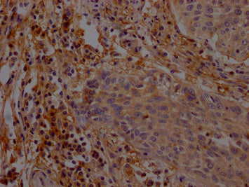 IHC image of CSB-PA892141LA01HU diluted at 1:200 and staining in paraffin-embedded human cervical cancer performed on a Leica BondTM system. After dewaxing and hydration, antigen retrieval was mediated by high pressure in a citrate buffer (pH 6.0). Section was blocked with 10% normal goat serum 30min at RT. Then primary antibody (1% BSA) was incubated at 4°C overnight. The primary is detected by a Goat anti-rabbit polymer IgG labeled by HRP and visualized using 0.05% DAB.