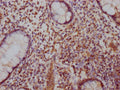 IHC image of CSB-PA892170LA01HU diluted at 1:100 and staining in paraffin-embedded human colon cancer performed on a Leica BondTM system. After dewaxing and hydration, antigen retrieval was mediated by high pressure in a citrate buffer (pH 6.0). Section was blocked with 10% normal goat serum 30min at RT. Then primary antibody (1% BSA) was incubated at 4°C overnight. The primary is detected by a Goat anti-rabbit IgG labeled by HRP and visualized using 0.05% DAB.