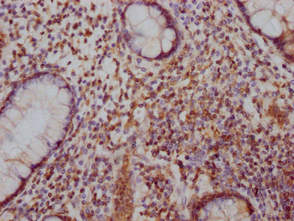 IHC image of CSB-PA892170LA01HU diluted at 1:100 and staining in paraffin-embedded human colon cancer performed on a Leica BondTM system. After dewaxing and hydration, antigen retrieval was mediated by high pressure in a citrate buffer (pH 6.0). Section was blocked with 10% normal goat serum 30min at RT. Then primary antibody (1% BSA) was incubated at 4°C overnight. The primary is detected by a Goat anti-rabbit IgG labeled by HRP and visualized using 0.05% DAB.
