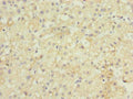 Immunohistochemistry of paraffin-embedded human liver cancer using CSB-PA892325LA01HU at dilution of 1:100