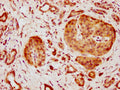 IHC image of CSB-PA892491LA01HU diluted at 1:600 and staining in paraffin-embedded human pancreatic cancer performed on a Leica BondTM system. After dewaxing and hydration, antigen retrieval was mediated by high pressure in a citrate buffer (pH 6.0). Section was blocked with 10% normal goat serum 30min at RT. Then primary antibody (1% BSA) was incubated at 4°C overnight. The primary is detected by a biotinylated secondary antibody and visualized using an HRP conjugated SP system.