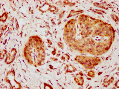 IHC image of CSB-PA892491LA01HU diluted at 1:600 and staining in paraffin-embedded human pancreatic cancer performed on a Leica BondTM system. After dewaxing and hydration, antigen retrieval was mediated by high pressure in a citrate buffer (pH 6.0). Section was blocked with 10% normal goat serum 30min at RT. Then primary antibody (1% BSA) was incubated at 4°C overnight. The primary is detected by a biotinylated secondary antibody and visualized using an HRP conjugated SP system.