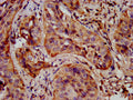 IHC image of CSB-PA892492LA01HU diluted at 1:400 and staining in paraffin-embedded human cervical cancer performed on a Leica BondTM system. After dewaxing and hydration, antigen retrieval was mediated by high pressure in a citrate buffer (pH 6.0). Section was blocked with 10% normal goat serum 30min at RT. Then primary antibody (1% BSA) was incubated at 4&deg;C overnight. The primary is detected by a biotinylated secondary antibody and visualized using an HRP conjugated SP system.