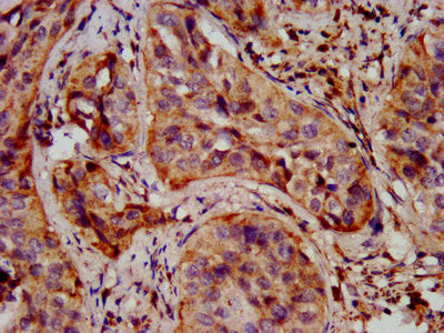 IHC image of CSB-PA892492LA01HU diluted at 1:400 and staining in paraffin-embedded human cervical cancer performed on a Leica BondTM system. After dewaxing and hydration, antigen retrieval was mediated by high pressure in a citrate buffer (pH 6.0). Section was blocked with 10% normal goat serum 30min at RT. Then primary antibody (1% BSA) was incubated at 4&deg;C overnight. The primary is detected by a biotinylated secondary antibody and visualized using an HRP conjugated SP system.