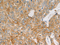 The image on the left is immunohistochemistry of paraffin-embedded Human lung cancer tissue using CSB-PA895516(MAP2K6 Antibody) at dilution 1/20, on the right is treated with fusion protein. (Original magnification: ×200)