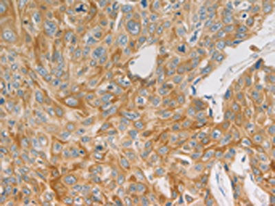 The image on the left is immunohistochemistry of paraffin-embedded Human lung cancer tissue using CSB-PA895516(MAP2K6 Antibody) at dilution 1/20, on the right is treated with fusion protein. (Original magnification: ×200)