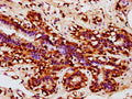 IHC image of CSB-PA896540LA01HU diluted at 1:300 and staining in paraffin-embedded human breast cancer performed on a Leica BondTM system. After dewaxing and hydration, antigen retrieval was mediated by high pressure in a citrate buffer (pH 6.0). Section was blocked with 10% normal goat serum 30min at RT. Then primary antibody (1% BSA) was incubated at 4°C overnight. The primary is detected by a biotinylated secondary antibody and visualized using an HRP conjugated SP system.