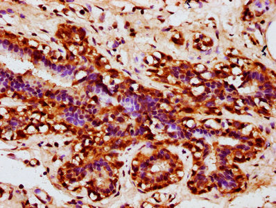 IHC image of CSB-PA896540LA01HU diluted at 1:300 and staining in paraffin-embedded human breast cancer performed on a Leica BondTM system. After dewaxing and hydration, antigen retrieval was mediated by high pressure in a citrate buffer (pH 6.0). Section was blocked with 10% normal goat serum 30min at RT. Then primary antibody (1% BSA) was incubated at 4°C overnight. The primary is detected by a biotinylated secondary antibody and visualized using an HRP conjugated SP system.