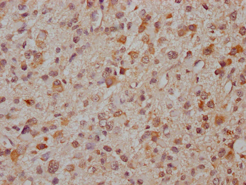 IHC image of CSB-PA897294LA01HU diluted at 1:300 and staining in paraffin-embedded human glioma cancer performed on a Leica BondTM system. After dewaxing and hydration, antigen retrieval was mediated by high pressure in a citrate buffer (pH 6.0). Section was blocked with 10% normal goat serum 30min at RT. Then primary antibody (1% BSA) was incubated at 4°C overnight. The primary is detected by a Goat anti-rabbit IgG labeled by HRP and visualized using 0.05% DAB.