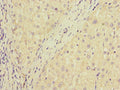 Immunohistochemistry of paraffin-embedded human liver cancer using CSB-PA897321ESR1HU at dilution of 1:100