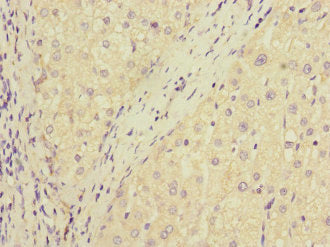 Immunohistochemistry of paraffin-embedded human liver cancer using CSB-PA897321ESR1HU at dilution of 1:100