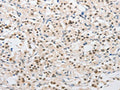 The image on the left is immunohistochemistry of paraffin-embedded Human thyroid cancer tissue using CSB-PA897667(SAE1 Antibody) at dilution 1/15, on the right is treated with fusion protein. (Original magnification: ×200)