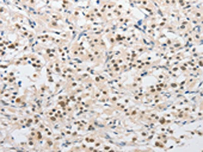 The image on the left is immunohistochemistry of paraffin-embedded Human thyroid cancer tissue using CSB-PA897667(SAE1 Antibody) at dilution 1/15, on the right is treated with fusion protein. (Original magnification: ×200)