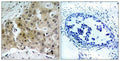 Immunohistochemical analysis of paraffin-embedded human breast carcinoma tissue using VEGFR2(Phospho-Tyr1175) Antibody(left) or the same antibody preincubated with blocking peptide(right).