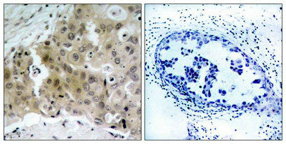 Immunohistochemical analysis of paraffin-embedded human breast carcinoma tissue using VEGFR2(Phospho-Tyr1175) Antibody(left) or the same antibody preincubated with blocking peptide(right).