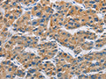 The image on the left is immunohistochemistry of paraffin-embedded Human liver cancer tissue using CSB-PA898117(CERK Antibody) at dilution 1/30, on the right is treated with fusion protein. (Original magnification: ×200)