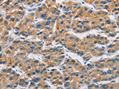 The image on the left is immunohistochemistry of paraffin-embedded Human liver cancer tissue using CSB-PA898117(CERK Antibody) at dilution 1/30, on the right is treated with fusion protein. (Original magnification: ×200)