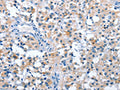 The image on the left is immunohistochemistry of paraffin-embedded Human thyroid cancer tissue using CSB-PA898565(ASB2 Antibody) at dilution 1/50, on the right is treated with fusion protein. (Original magnification: ×200)