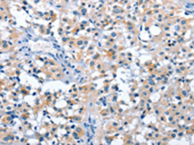 The image on the left is immunohistochemistry of paraffin-embedded Human thyroid cancer tissue using CSB-PA898565(ASB2 Antibody) at dilution 1/50, on the right is treated with fusion protein. (Original magnification: ×200)
