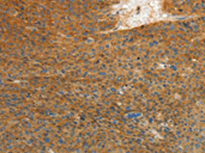 The image on the left is immunohistochemistry of paraffin-embedded Human liver cancer tissue using CSB-PA898666(PRKCA Antibody) at dilution 1/10, on the right is treated with fusion protein. (Original magnification: ×200)