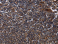 The image on the left is immunohistochemistry of paraffin-embedded Human tonsil tissue using CSB-PA898702(NTMT1 Antibody) at dilution 1/40, on the right is treated with fusion protein. (Original magnification: ×200)