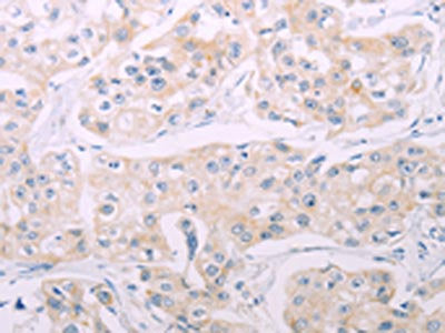The image on the left is immunohistochemistry of paraffin-embedded Human breast cancer tissue using CSB-PA898784(ADCY7 Antibody) at dilution 1/60, on the right is treated with synthetic peptide. (Original magnification: ×200)