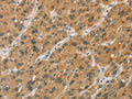The image on the left is immunohistochemistry of paraffin-embedded Human liver cancer tissue using CSB-PA898841(CYP11A1 Antibody) at dilution 1/50, on the right is treated with fusion protein. (Original magnification: ×200)