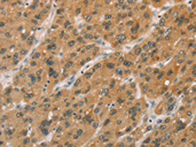 The image on the left is immunohistochemistry of paraffin-embedded Human liver cancer tissue using CSB-PA898841(CYP11A1 Antibody) at dilution 1/50, on the right is treated with fusion protein. (Original magnification: ×200)