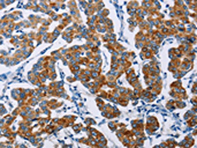 The image on the left is immunohistochemistry of paraffin-embedded Human breast cancer tissue using CSB-PA899163(NCR3 Antibody) at dilution 1/40, on the right is treated with fusion protein. (Original magnification: ×200)