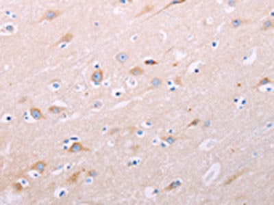 The image on the left is immunohistochemistry of paraffin-embedded Human brain tissue using CSB-PA899170(ADCY5 Antibody) at dilution 1/40, on the right is treated with synthetic peptide. (Original magnification: ×200)