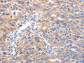 The image on the left is immunohistochemistry of paraffin-embedded Human ovarian cancer tissue using CSB-PA899249(RCHY1 Antibody) at dilution 1/30, on the right is treated with fusion protein. (Original magnification: ×200)