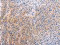 The image on the left is immunohistochemistry of paraffin-embedded Human liver cancer tissue using CSB-PA899511(ADHFE1 Antibody) at dilution 1/60, on the right is treated with synthetic peptide. (Original magnification: ×200)