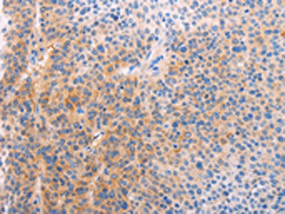 The image on the left is immunohistochemistry of paraffin-embedded Human liver cancer tissue using CSB-PA899511(ADHFE1 Antibody) at dilution 1/60, on the right is treated with synthetic peptide. (Original magnification: ×200)