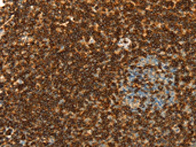The image is immunohistochemistry of paraffin-embedded Human tonsil tissue using CSB-PA899858(SPN Antibody) at dilution 1/30. (Original magnification: ×200)