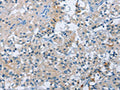 The image on the left is immunohistochemistry of paraffin-embedded Human thyroid cancer tissue using CSB-PA899996(BTN2A2 Antibody) at dilution 1/50, on the right is treated with fusion protein. (Original magnification: ×200)