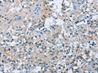 The image on the left is immunohistochemistry of paraffin-embedded Human thyroid cancer tissue using CSB-PA899996(BTN2A2 Antibody) at dilution 1/50, on the right is treated with fusion protein. (Original magnification: ×200)
