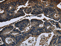 The image on the left is immunohistochemistry of paraffin-embedded Human colon cancer tissue using CSB-PA900410(DHCR7 Antibody) at dilution 1/20, on the right is treated with fusion protein. (Original magnification: ×200)