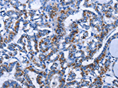 The image on the left is immunohistochemistry of paraffin-embedded Human thyroid cancer tissue using CSB-PA900471(MMP16 Antibody) at dilution 1/40, on the right is treated with fusion protein. (Original magnification: ×200)