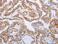 The image on the left is immunohistochemistry of paraffin-embedded Human thyroid cancer tissue using CSB-PA900594(DTX2 Antibody) at dilution 1/15, on the right is treated with fusion protein. (Original magnification: ×200)