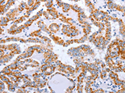 The image on the left is immunohistochemistry of paraffin-embedded Human thyroid cancer tissue using CSB-PA900594(DTX2 Antibody) at dilution 1/15, on the right is treated with fusion protein. (Original magnification: ×200)