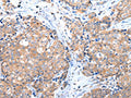 The image on the left is immunohistochemistry of paraffin-embedded Human breast cancer tissue using CSB-PA900627(GRB14 Antibody) at dilution 1/35, on the right is treated with fusion protein. (Original magnification: ×200)