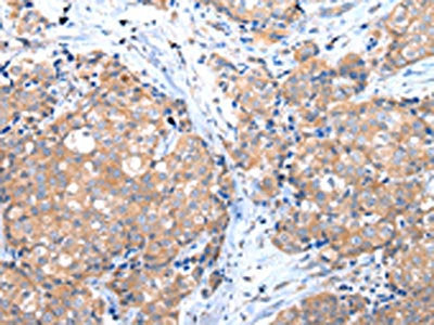 The image on the left is immunohistochemistry of paraffin-embedded Human breast cancer tissue using CSB-PA900627(GRB14 Antibody) at dilution 1/35, on the right is treated with fusion protein. (Original magnification: ×200)