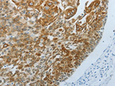 The image on the left is immunohistochemistry of paraffin-embedded Human cervical cancer tissue using CSB-PA900875(TP63 Antibody) at dilution 1/20, on the right is treated with fusion protein. (Original magnification: x200)
