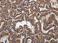 The image on the left is immunohistochemistry of paraffin-embedded Human thyroid cancer tissue using CSB-PA900886(KLK6 Antibody) at dilution 1/60, on the right is treated with fusion protein. (Original magnification: ×200)